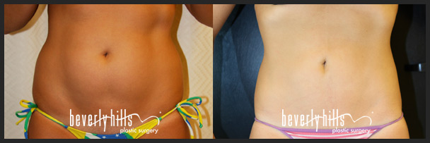 Before and after female liposuction (front)-1