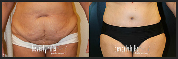 Before and after tummy tuck female-1
