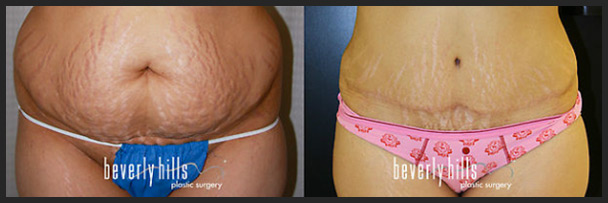 Before and after tummy tuck female-2