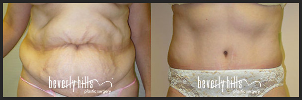 Before and after tummy tuck female-3