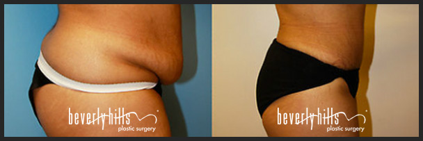 Before and after tummy tuck female-4