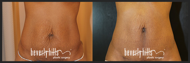 Before and after tummy tuck female-5