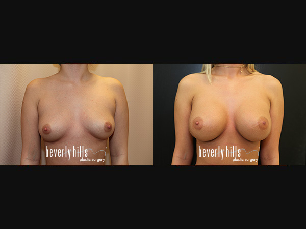 breast_aug-2015.06.25-da
