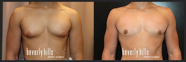 Before and after male breast augmentation (gynecomastia treatment) example #1