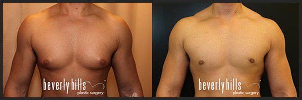 Before and after male breast augmentation (gynecomastia treatment) -2