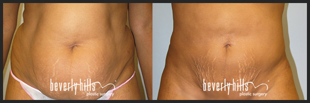 Before and after female liposuction (front)-3