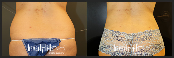 Before and after female liposuction (front)-5