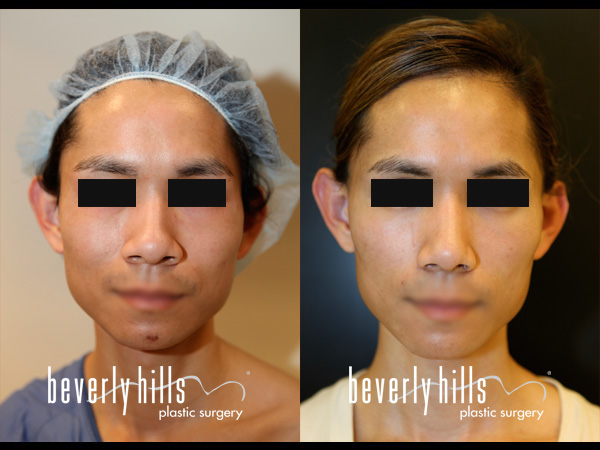 rhinoplasty-01a-12-8-14