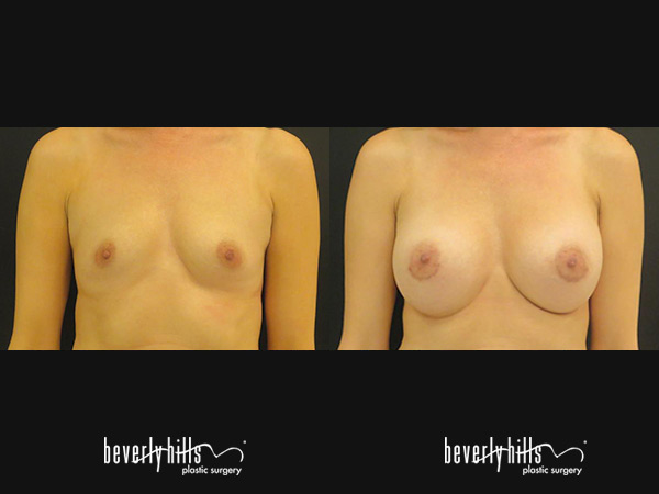 breast-aug2015b