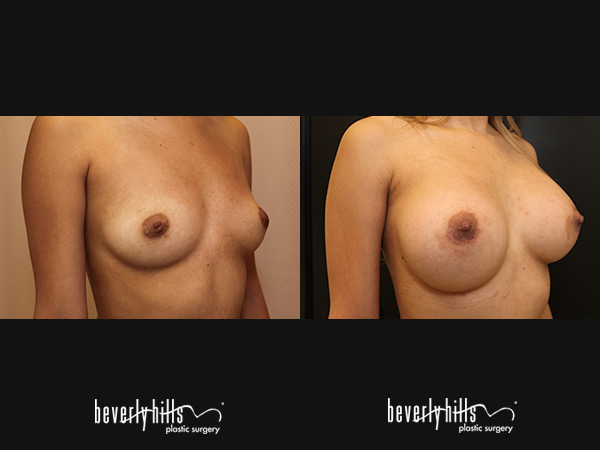breast-aug2015-2