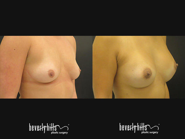 breast-aug2015-3