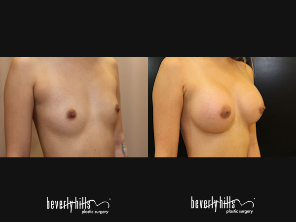 breast-aug2015-4