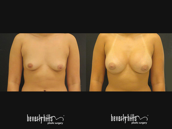 breast-aug2015-5