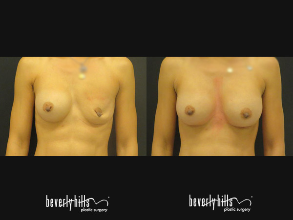 Breast Revision Before After