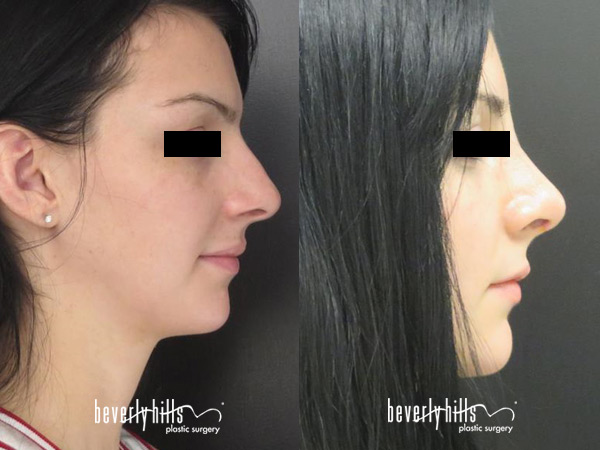 rhinoplasty-patient1-2015