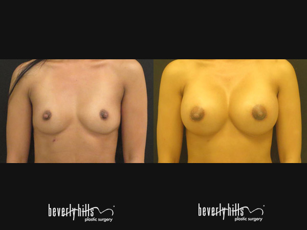 breast-aug1