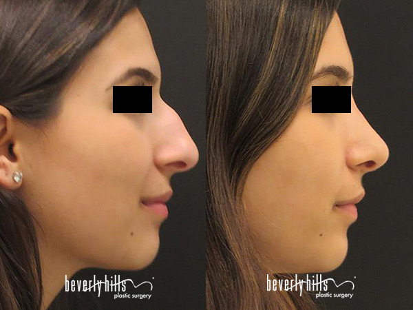 gallery-rhinoplasty1