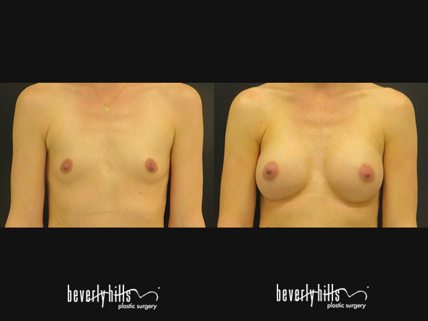 breast_augmentation-1g