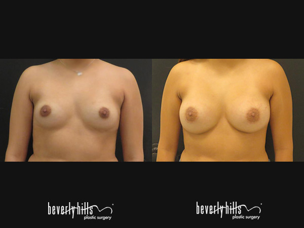 breast_augmentation1h