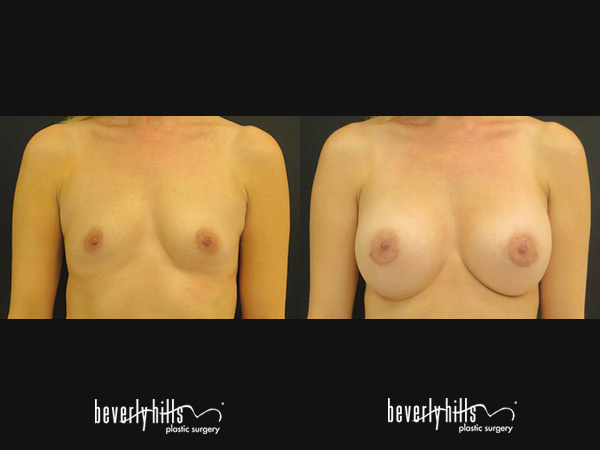 breast_augmentation1i