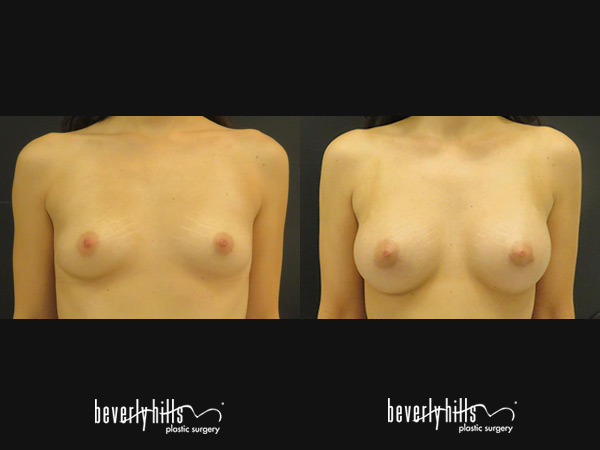 breast_augmentation1j