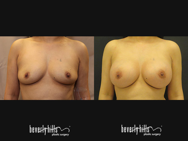 breast_augmentation1k