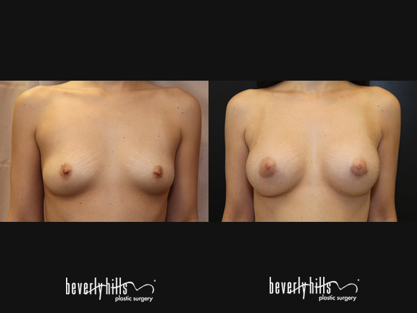 breast-aug148a