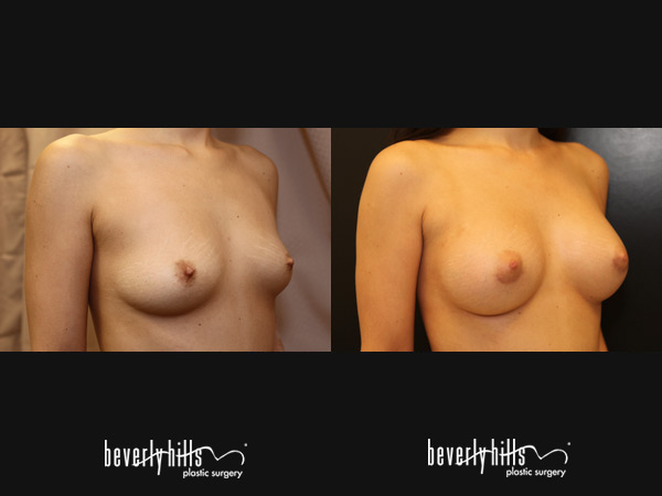 breast-aug148b