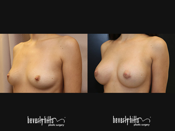 breast-aug148c