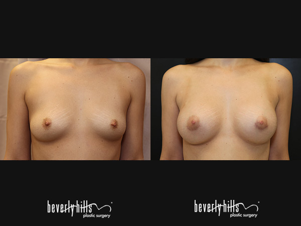 gallery-breast-155