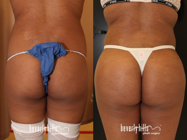 before-after-butt1