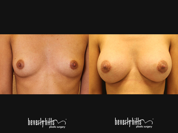 breast-aug-bA1