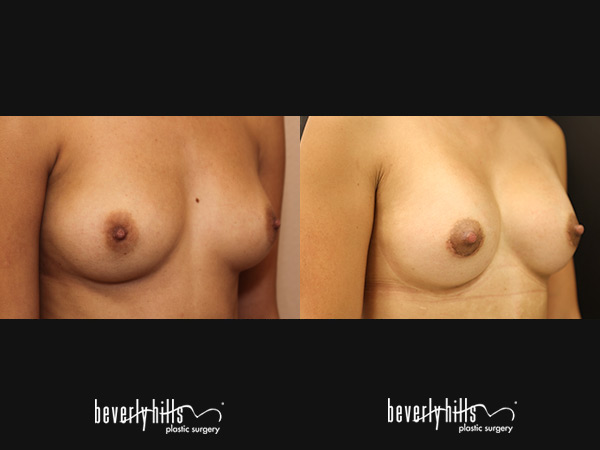 breast-aug-bA3