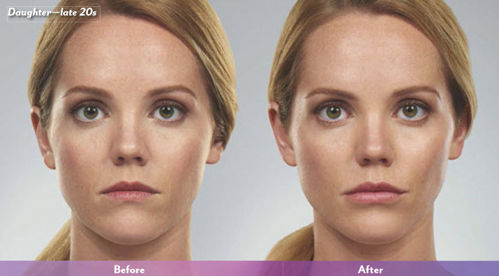 juvederm-before-after-1