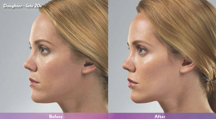 juvederm-before-after-2