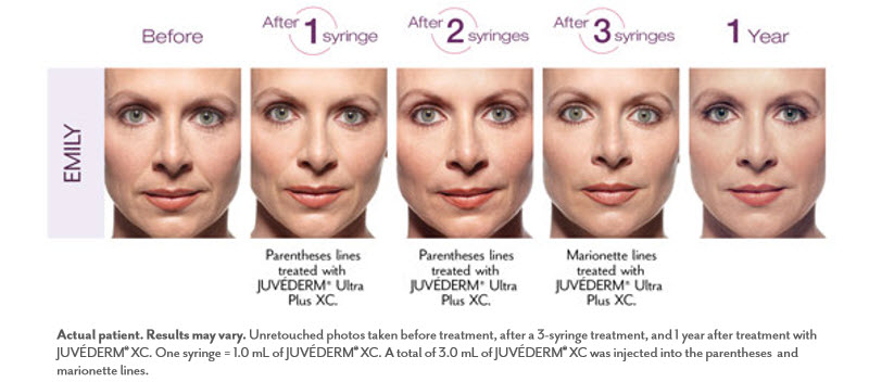 juvederm-effectiveness-before-after