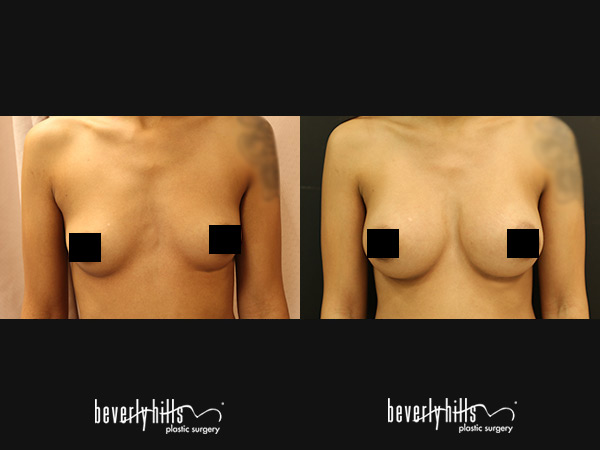 breast-167a