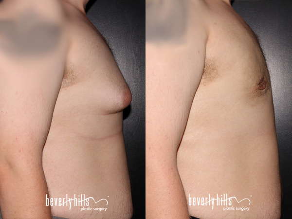 gynecomastia1