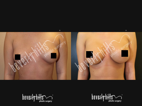 breast implant before and after 1