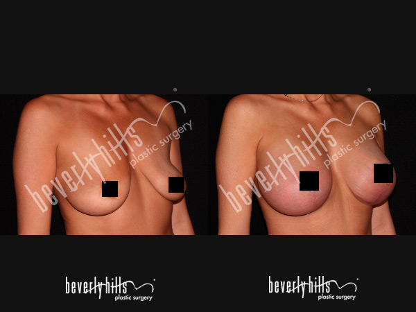 breast-177