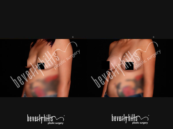 breast-patient-2d