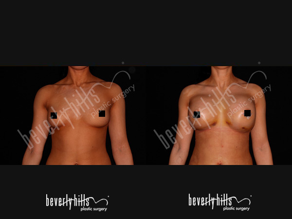 breast-patient-3a