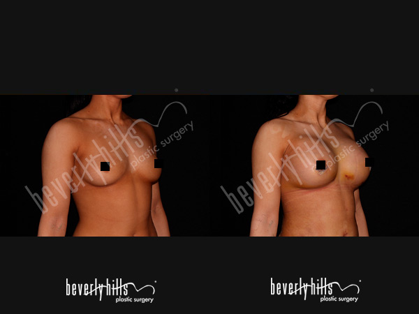 breast-patient-3b