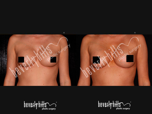 breast-patient-5a
