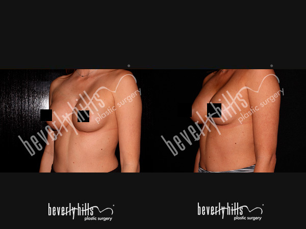 breast-patient-5d