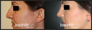 Chiu Rhinoplasty Nose Job Patient