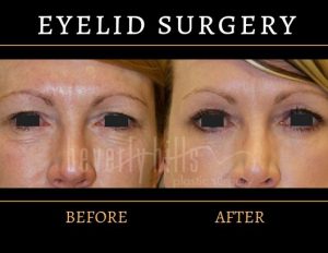 Eyelid Surgery Before and After 