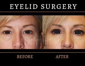 Eyelid Surgery Before and After 