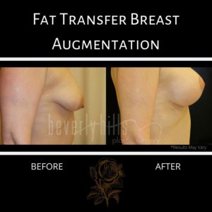 Using fat transfer for breast augmentation often results in breasts that are visibly fuller, as shown in this before and after shot.