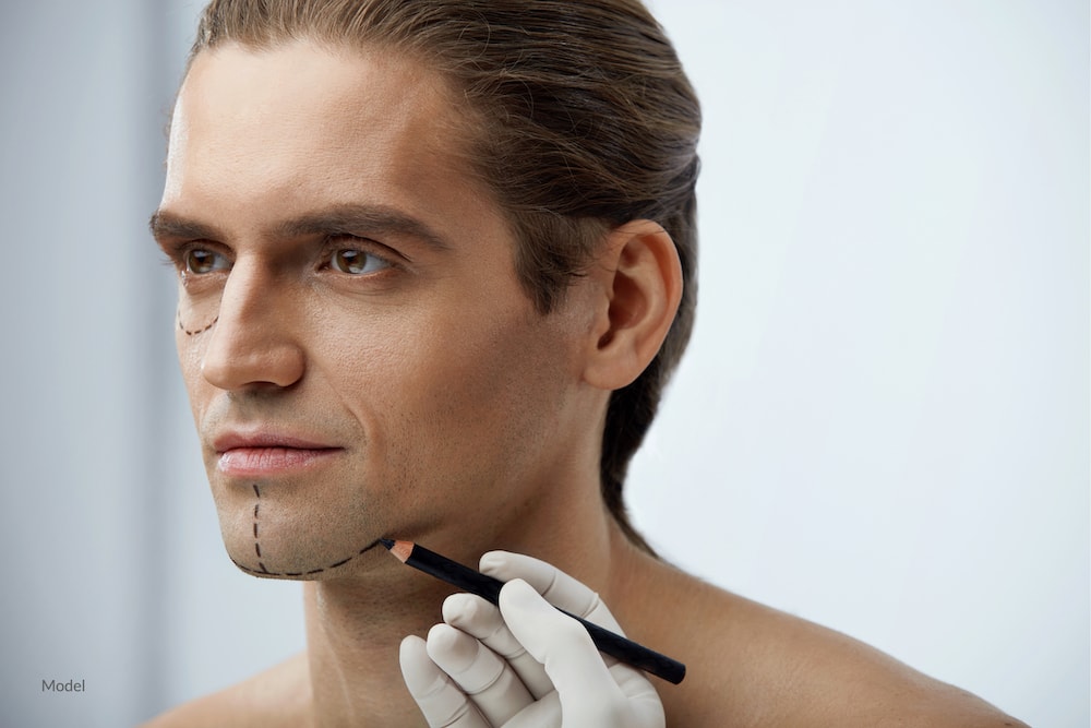 Man with Lines On Chin Before Chin Surgery Operation.